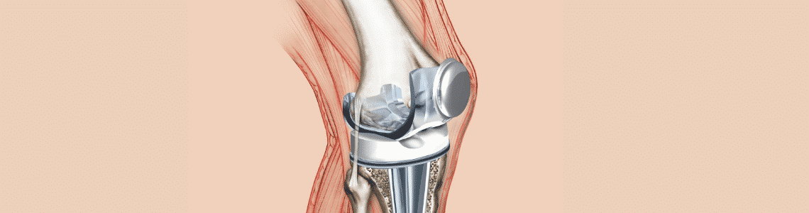 Patellofemoral Tracking Syndrome: What is It?