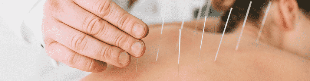 A doctor placing acupuncture needles on woman's back