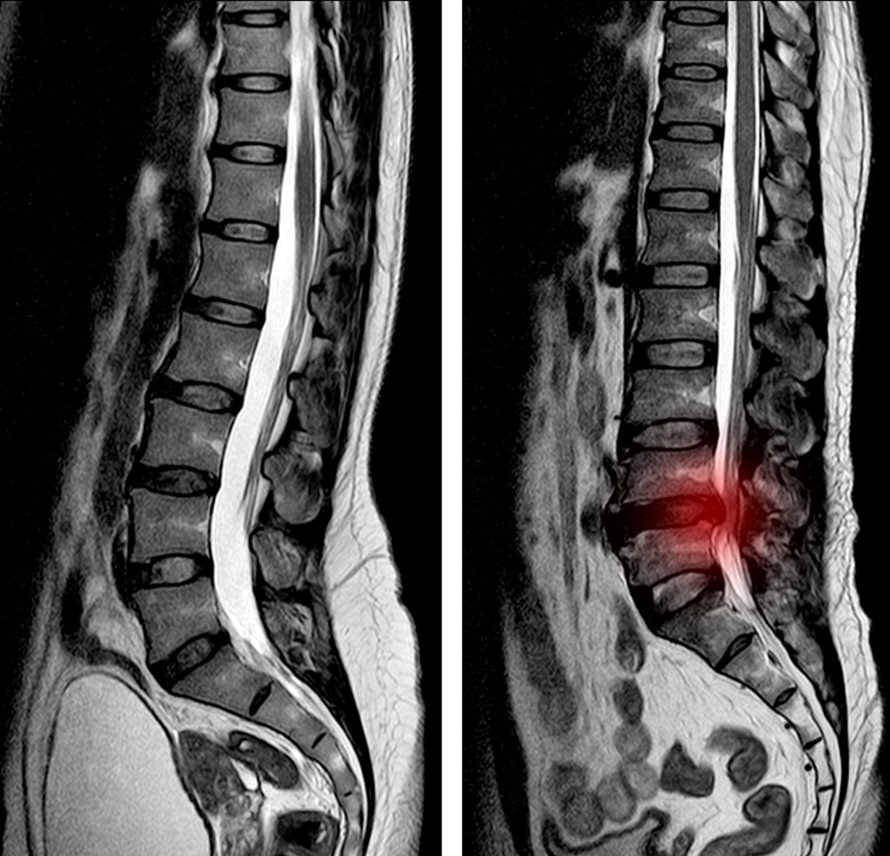 MRI Lumbar spine scan sagittal view Lumbosacral spine has straightening lumbar alignment