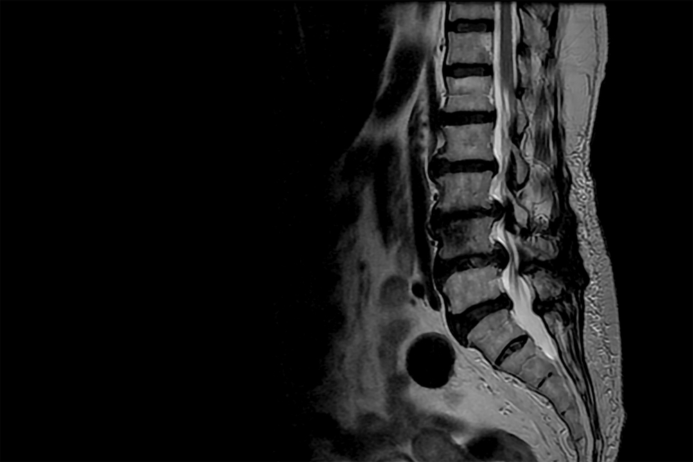 Scan of lumbosacral spine in lateral projection shown spinal canal stenosis